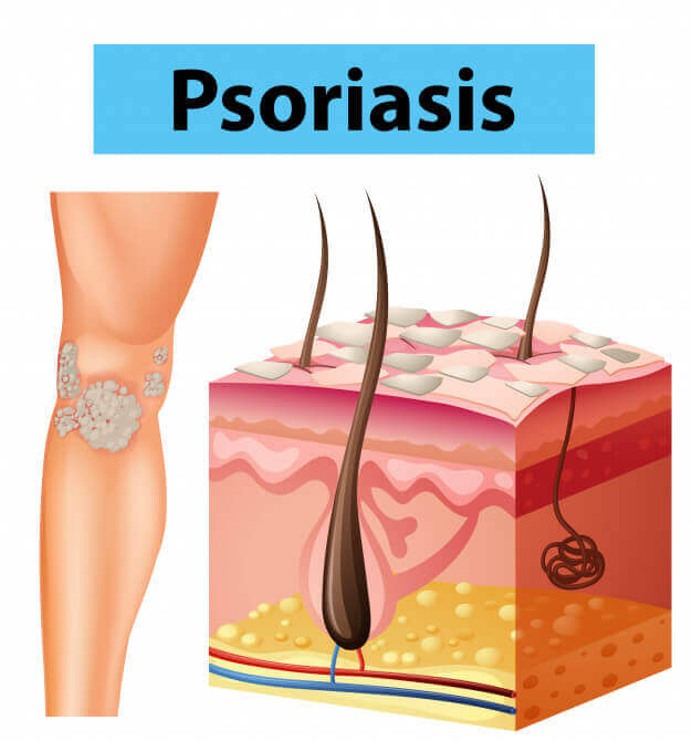 Langkah Pencegahan Psoriasis & Tips Menghindari Pencetus