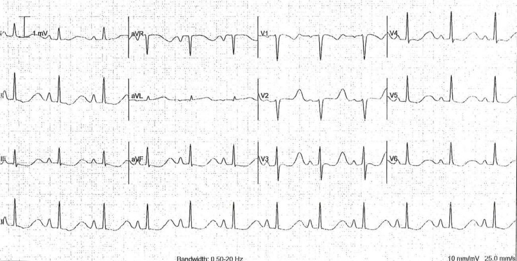 Contoh EKG untuk rule-of-fours