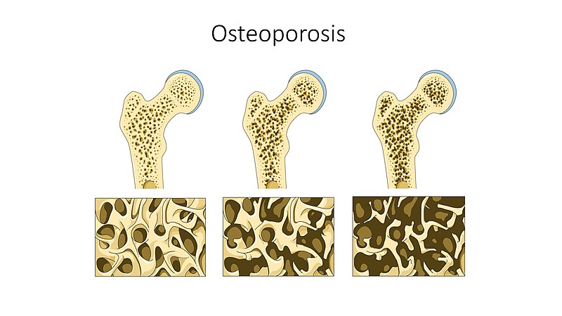 Perkembangan Penyakit Tulang Osteopenia menjadi Osteoporosis